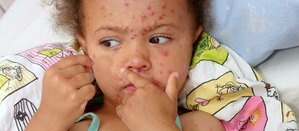 Measles - Symptoms,Causes, Diagnosis